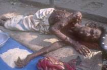 Old man suffering from Neurofibromatosis with his whole body and face covered in bumps begging to make a living.