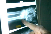 Emergency room doctor pointing at x-ray of broken wrist of 90 year old woman.