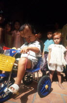 Child victim of Agent Orange chemical.