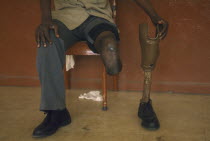 Mine victim holding prosthetic limb.Central Hospital