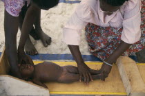 Baby girl being measured in day feeding centre for malnourished children in camp for Angolan refugees. Center