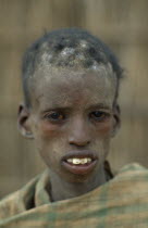 Severely malnourished boy at CONCERN feeding centre. Center