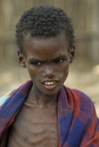 Severely malnourished child at CONCERN feeding centre. Center