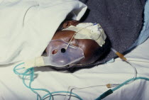 Dehydrated infant on drip and wearing oxygen mask.