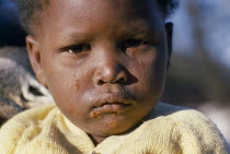 Portrait of young child with dirty  tear stained face and sores around mouth.township  poverty