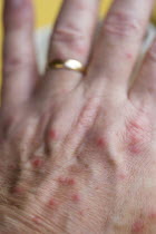 Hand of a white caucasian man with mosquito bites.Caribbean Destination Destinations Grenadian Greneda West Indies Grenada Male Men Guy One individual Solo Lone Solitary