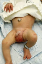 Children, Babies, New Born, Five day old baby with swollen enlarged gentials and umbical stump showing.
