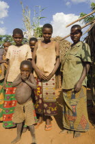 Burundi, Kirundo, A family beside the road living in poverty, child with obvious worms.