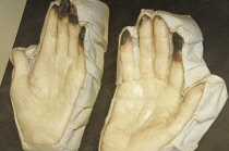Scotland, Edinburgh, Surgeons Hall Museum, wax cast of hands with gangrene.